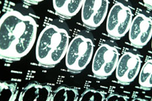 Brain And Head Injury Claims